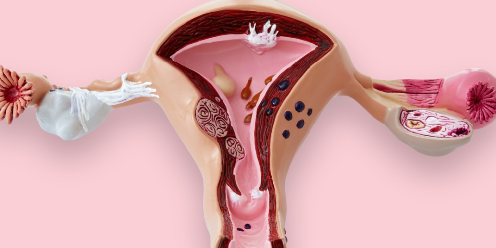 Síndrome de ovario poliquístico (SOP)